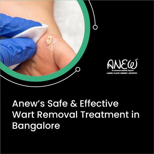 wart removal treatment​ in Bangalore